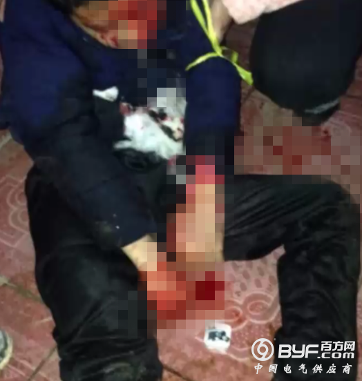 三无MP3突然爆炸 男孩被炸成重伤现仍在医院救治